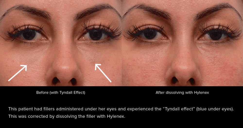 The Ultimate Guide to Dermal Fillers for the San Francisco Bay Area