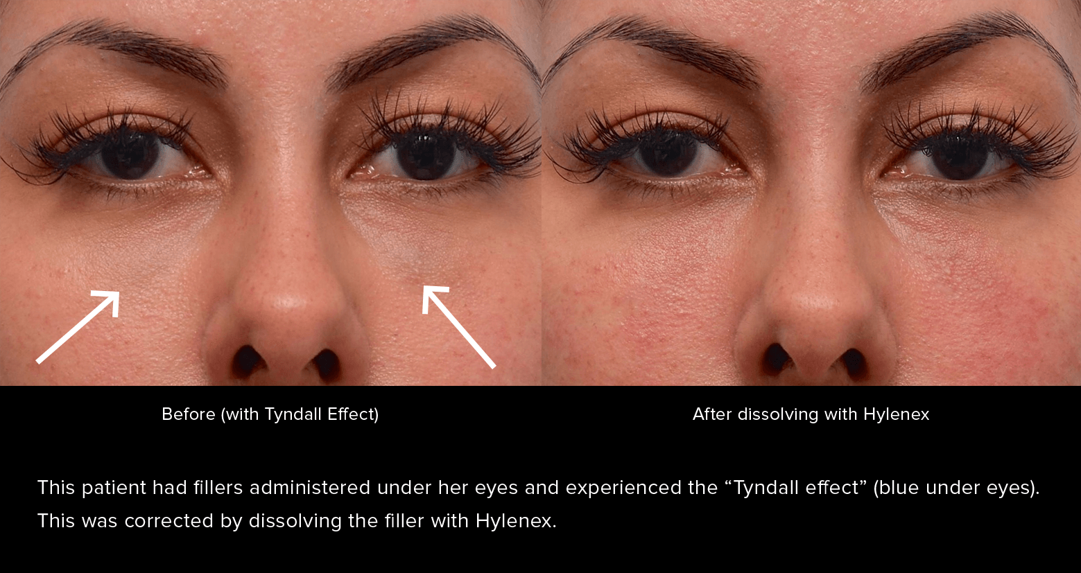 Under-eye filler before and after. This patient had fillers administered under her eyes and experienced the Tyndall effect (blue under eyes). This was corrected by dissolving the filler with Hylenex.