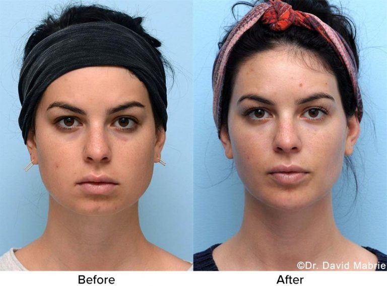 Nonsurgical Chin Augmentation, Neck Slimming & Jaw Contouring in San