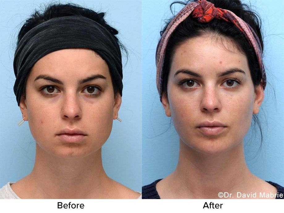 Nonsurgical Chin Augmentation, Neck Slimming & Jaw Contouring in San Francisco Dr. David C. Mabrie