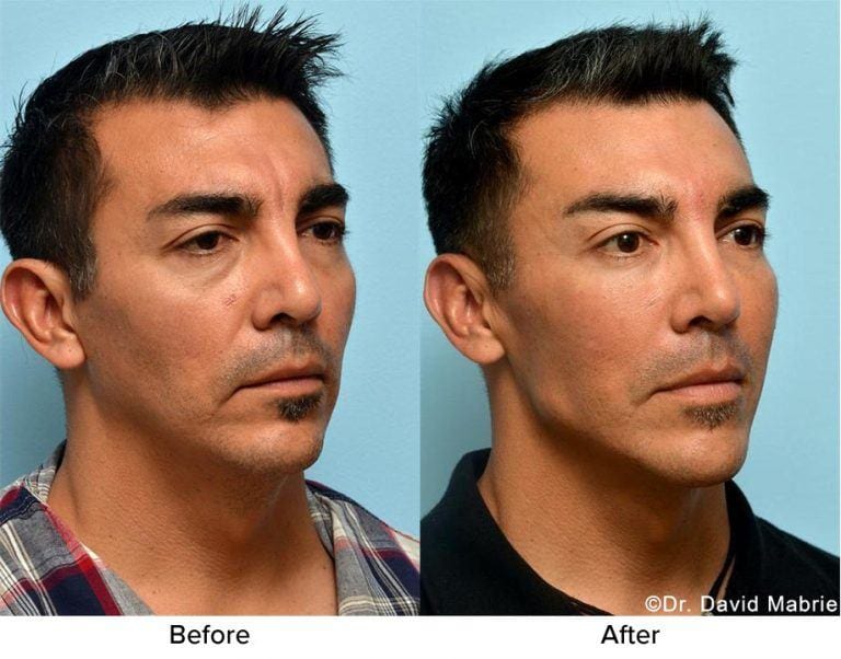 Nonsurgical Chin Augmentation, Neck Slimming & Jaw Contouring in San