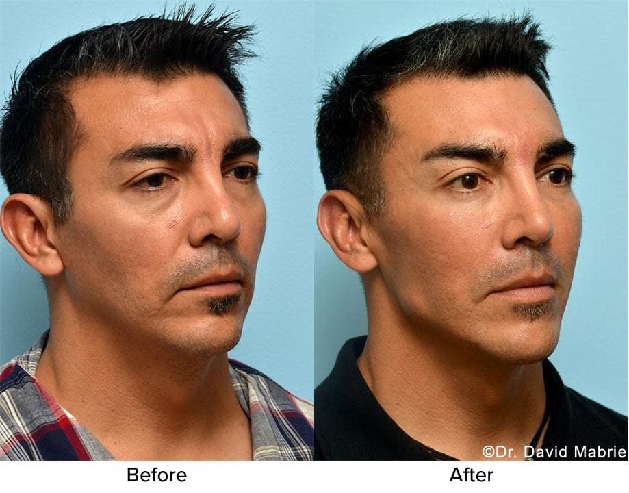 Nonsurgical Chin Augmentation, Neck Slimming & Jaw Contouring in San