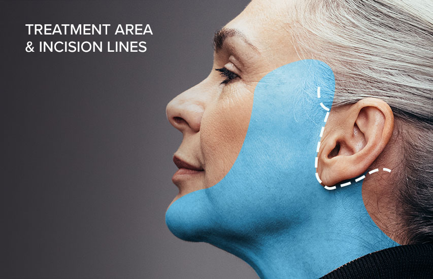 facelift treatment area and incision lines