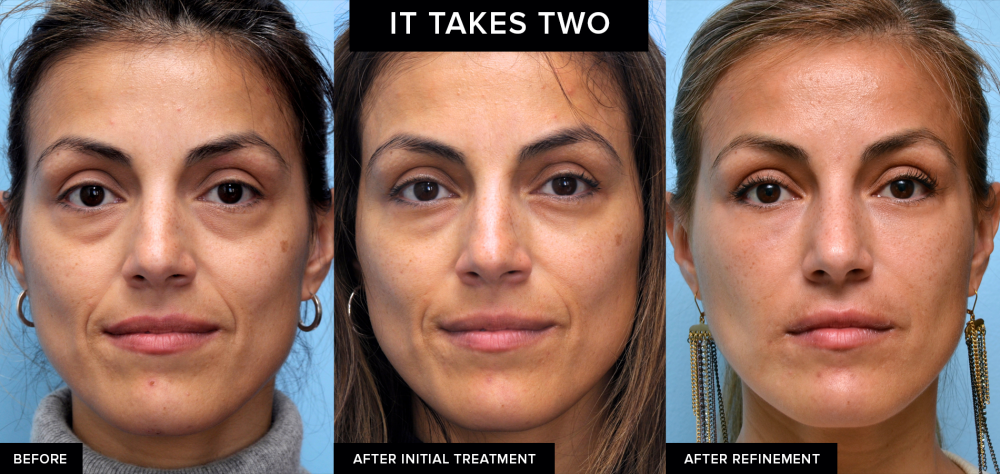 Dermal filler results created by Dr. David Mabrie in San Francisco, CA after a series of treatments.