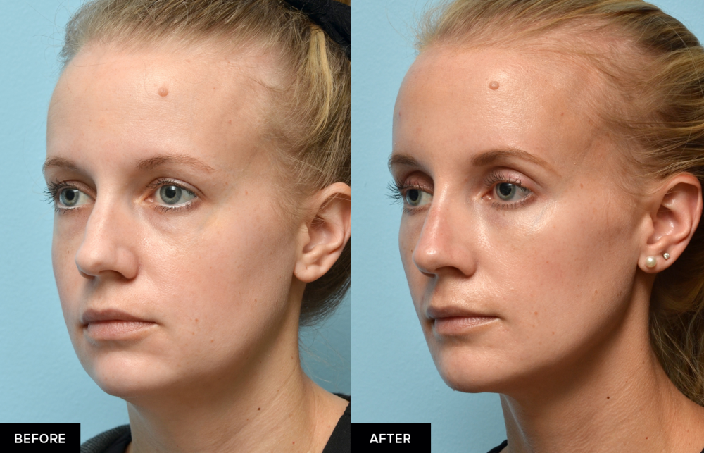 Female before and after jawline fillers