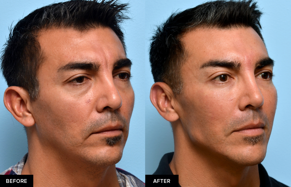 jawline and chin filler before and after from MFI in San Francisco