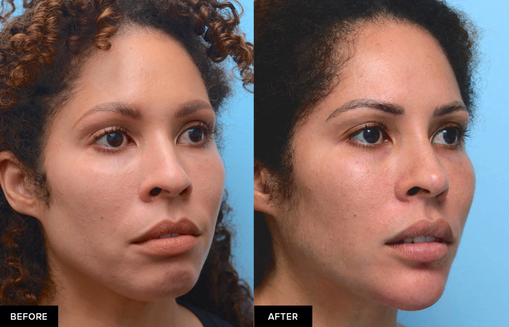 jawline filler before and after from MFI in San Francisco