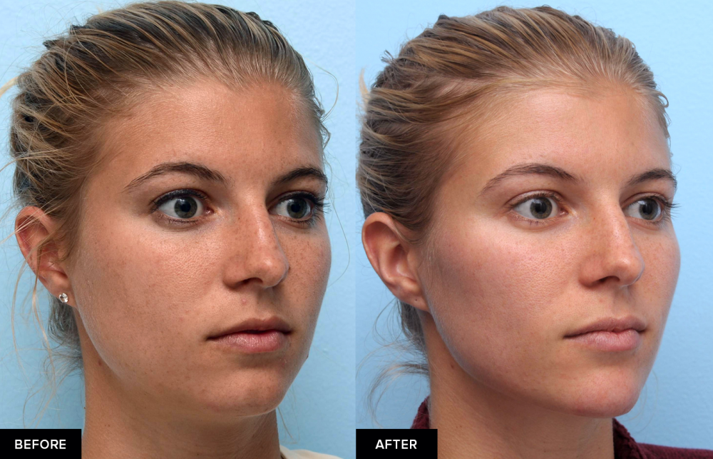 jawline filler before and after from MFI in San Francisco