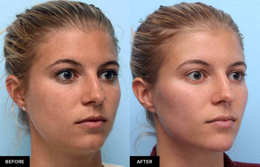 How to Get a Better Jawline - Procedures for a Chiseled Jaw