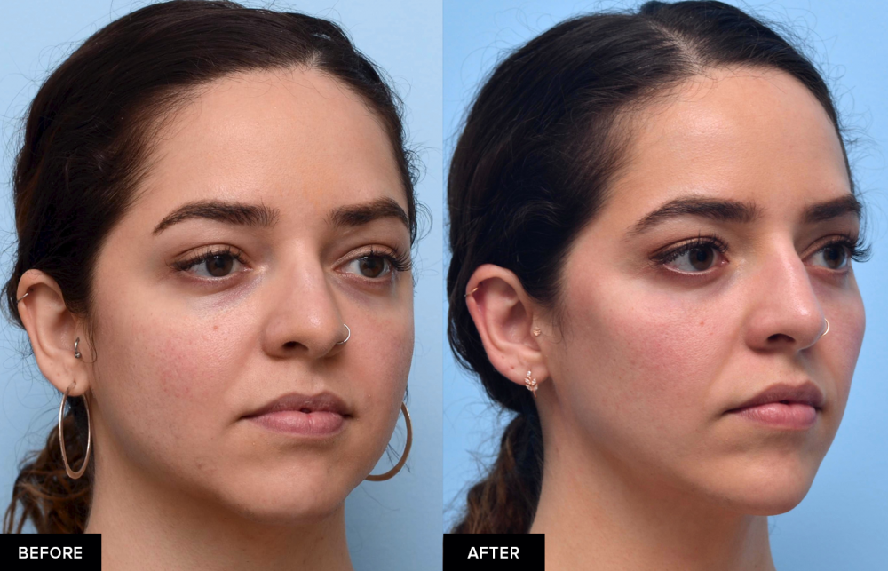 jawline and chin filler before and after from MFI in San Francisco