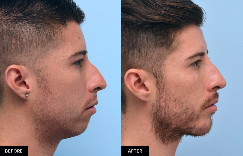 jawline filler before and after from MFI in San Francisco