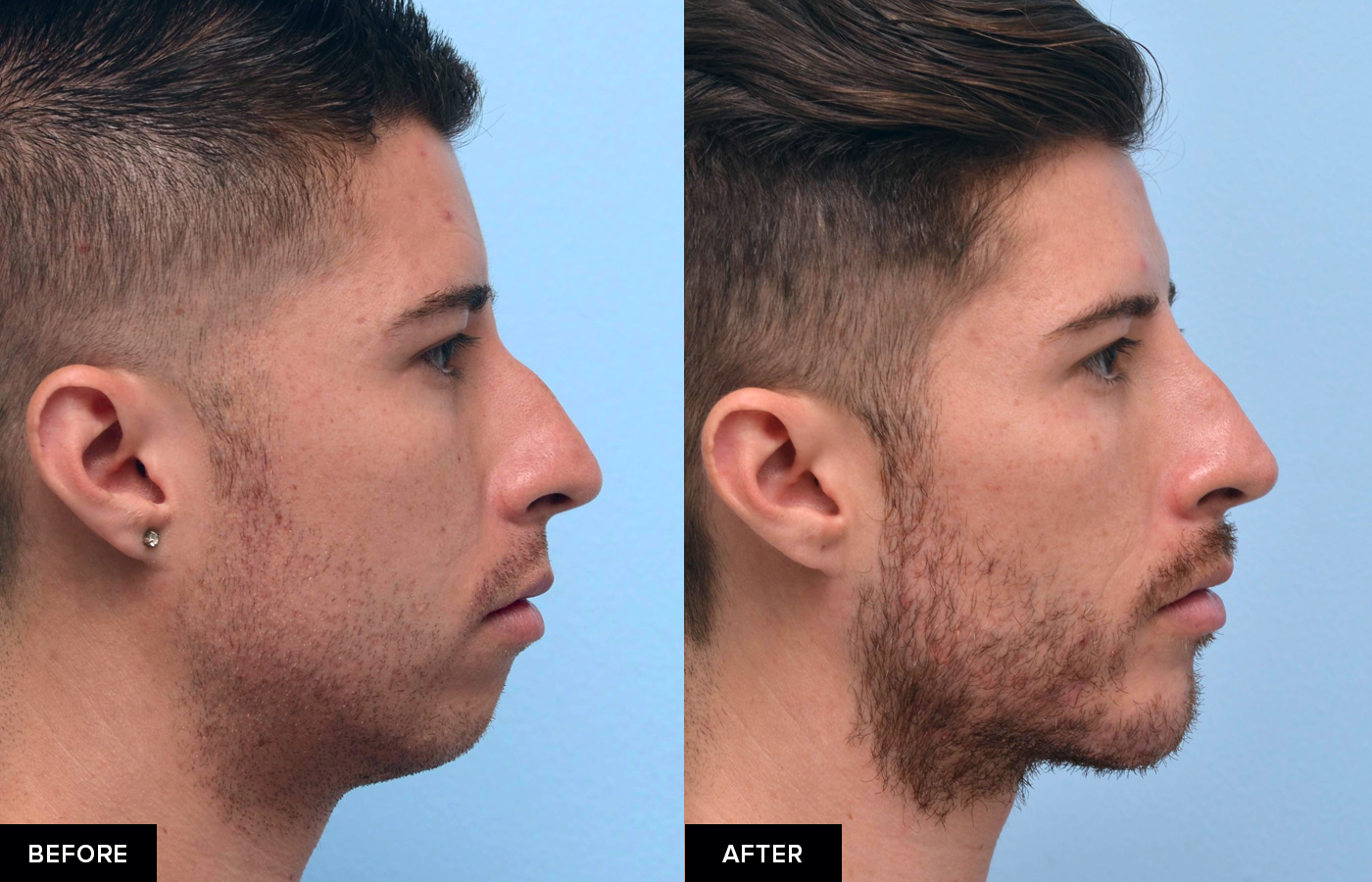 For men’s jawline filler treatments, the goal is to sculpt a chiseled jawli...
