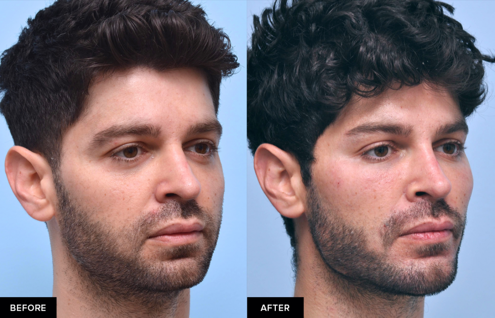Male before and after jawline fillers