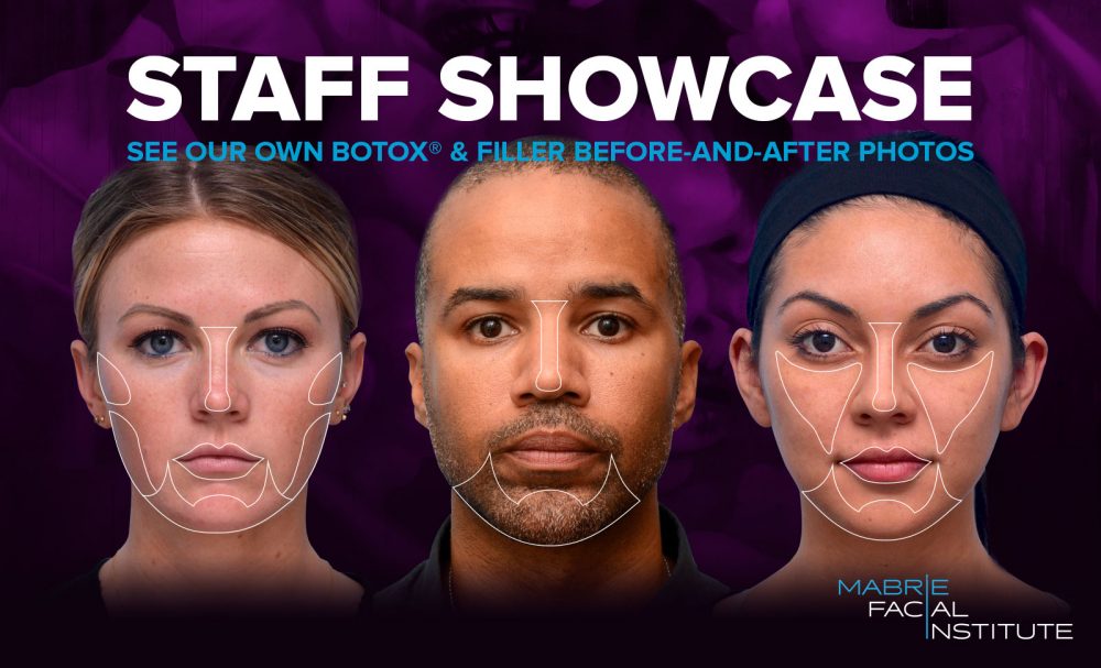 Staff Showcase: See Our Own BOTOX & Filler Results