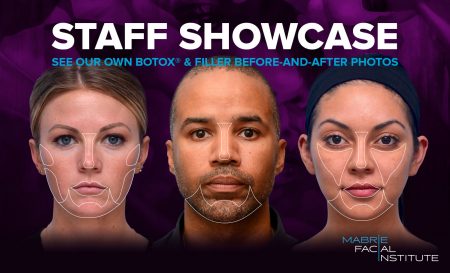 Staff Showcase: See Our Own BOTOX & Filler Results