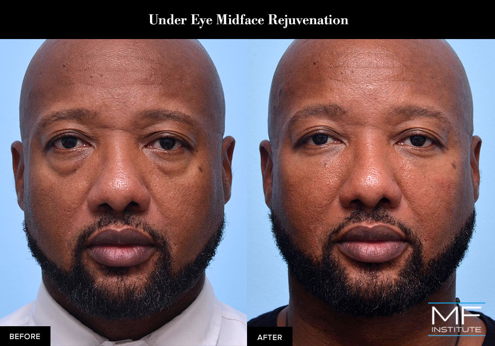 Upper face rejuvenation of the eyes using dermal fillers