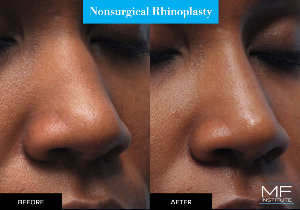 nonsurgical nose job with fillers before and after