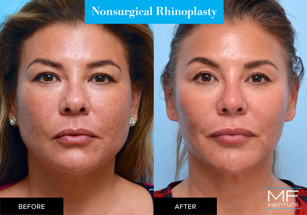 nonsurgical rhinoplasty with fillers before & after