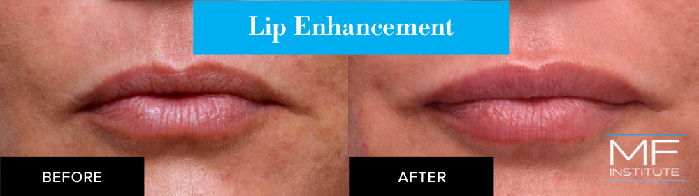 lip enhancement before and after