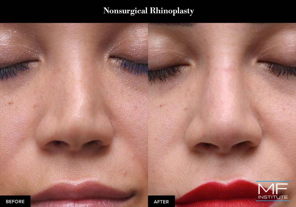 Nonsurgical rhinoplasty results created with fillers