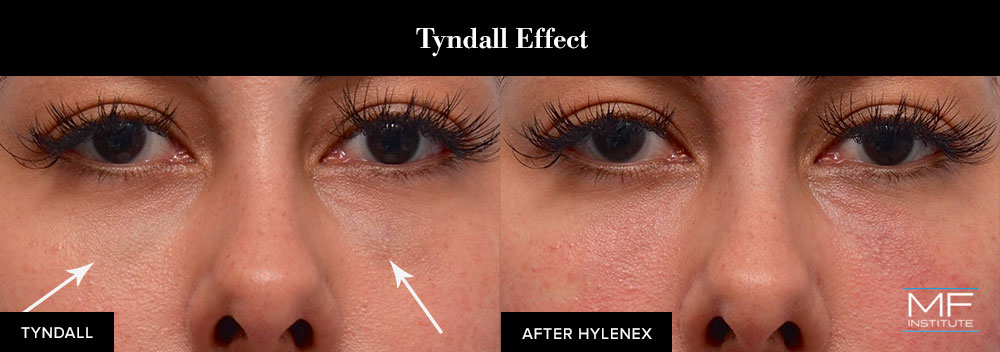 The Tyndall effect can be treated using Hylenex.