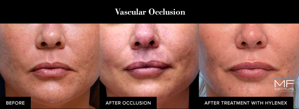 before, during, and after vascular occlusion from dermal filler injections.