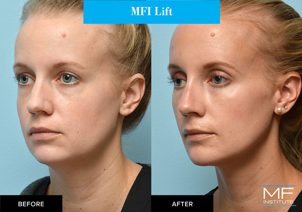 MFI lift (liquid facelift) with fillers before and after