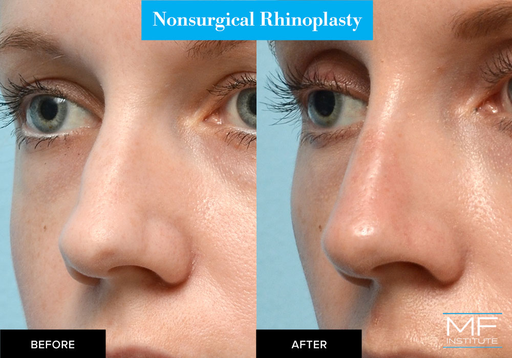 nonsurgical rhinoplasty with fillers before and after