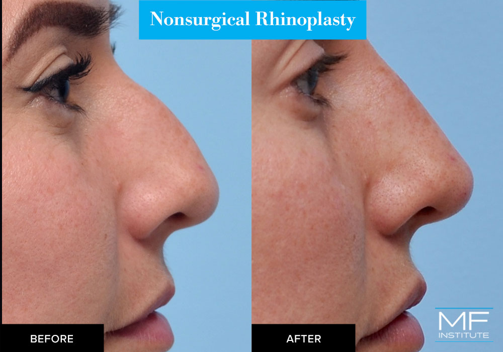 nonsurgical rhinoplasty with fillers before and after