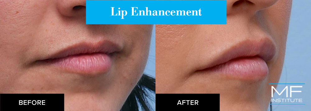 lip enhancement with fillers before and after