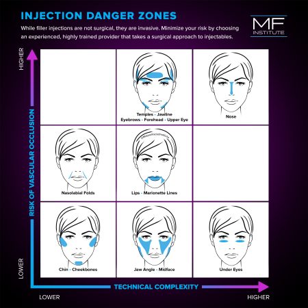 dermal filler injection danger zones diagram