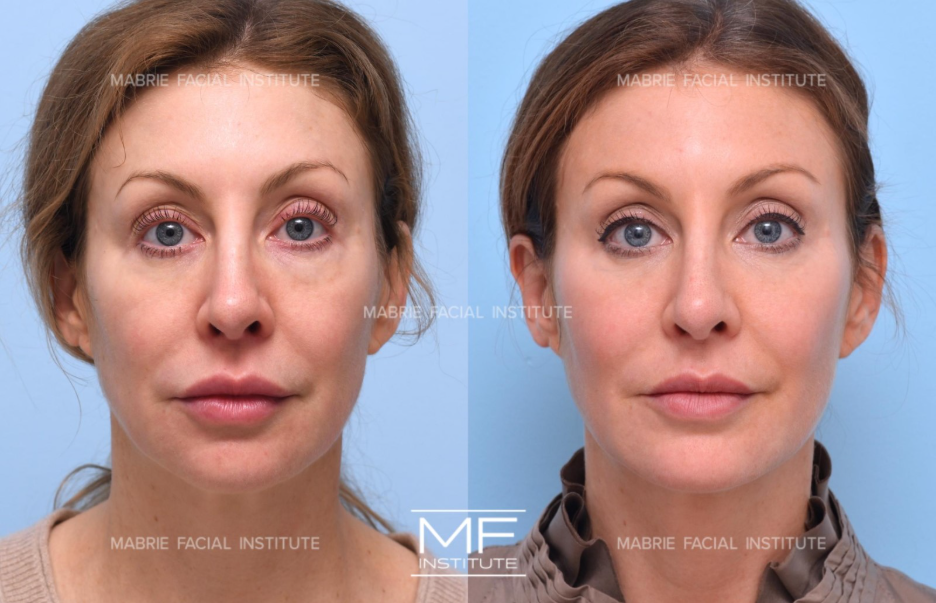 before and after corrective filler treatment