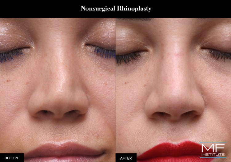 before and after a nonsurgical rhinoplasty