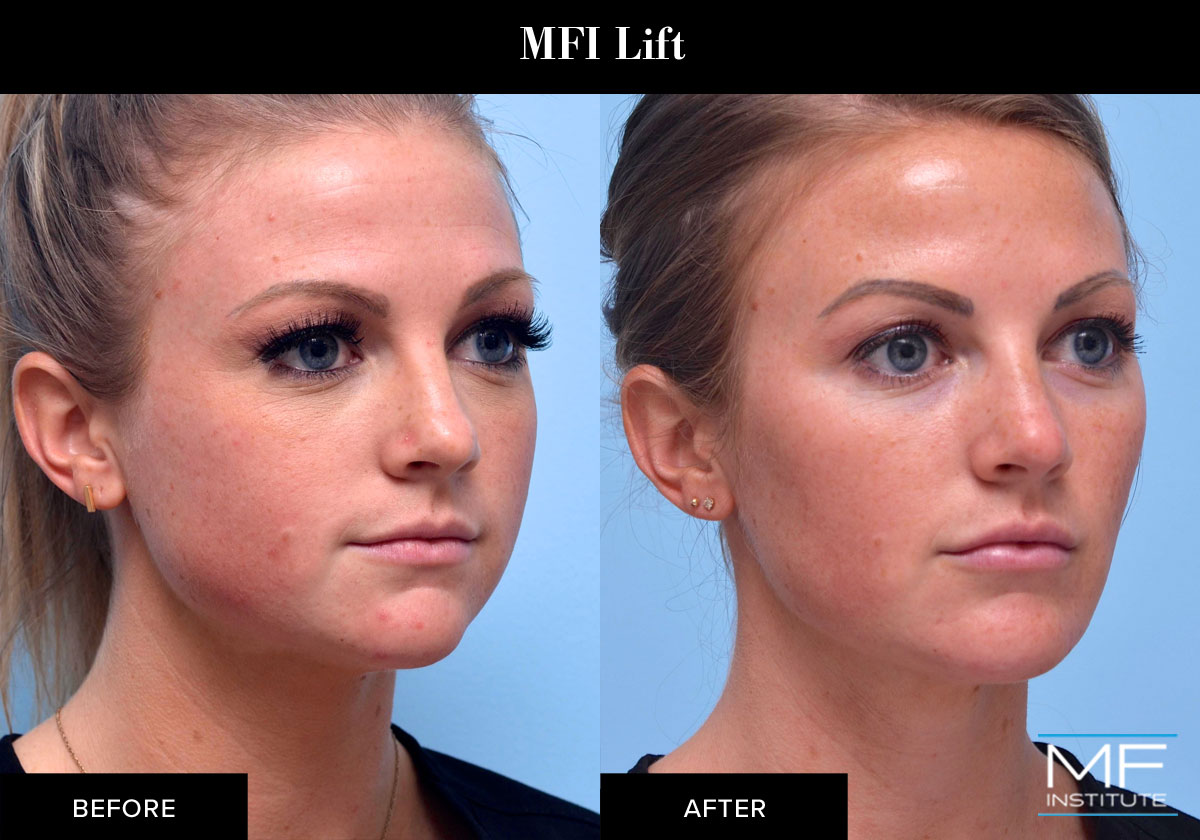 Full face contouring with fillers and BOTOX
