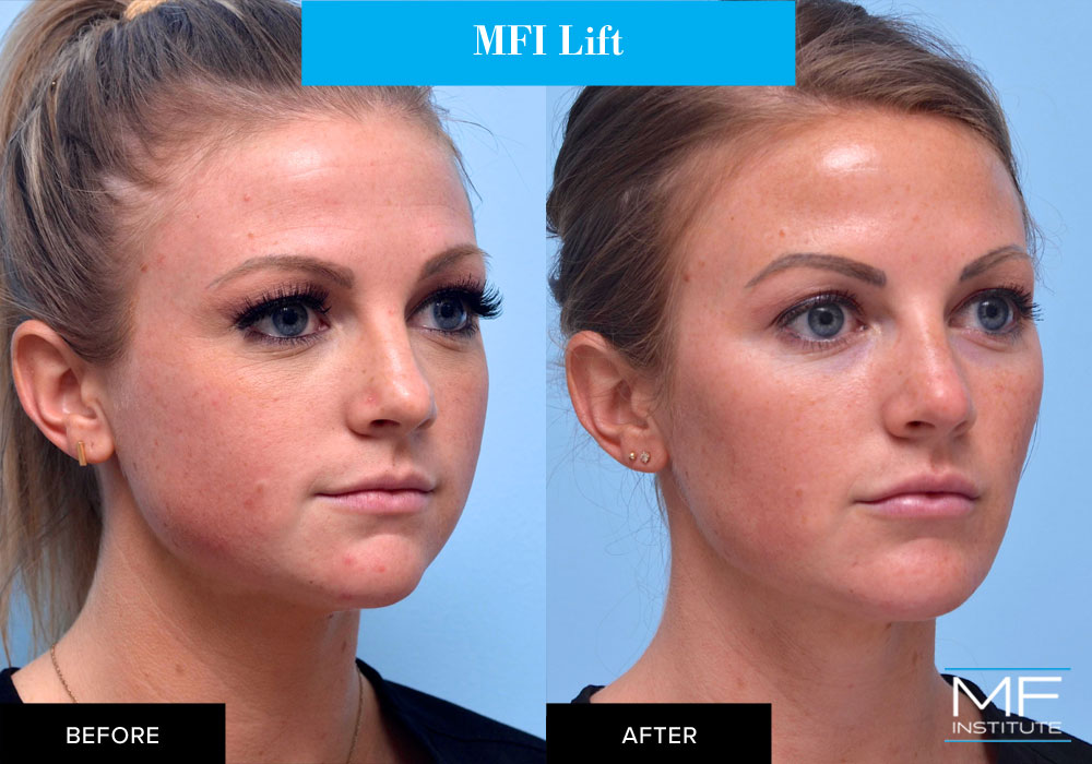 Full face contouring with fillers and BOTOX before and after