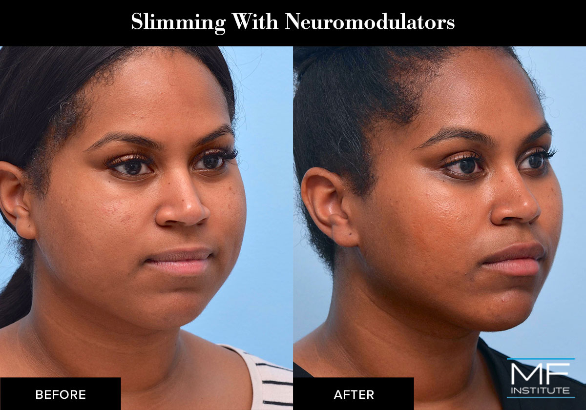 Facial slimming with neuromodulators such as BOTOX.