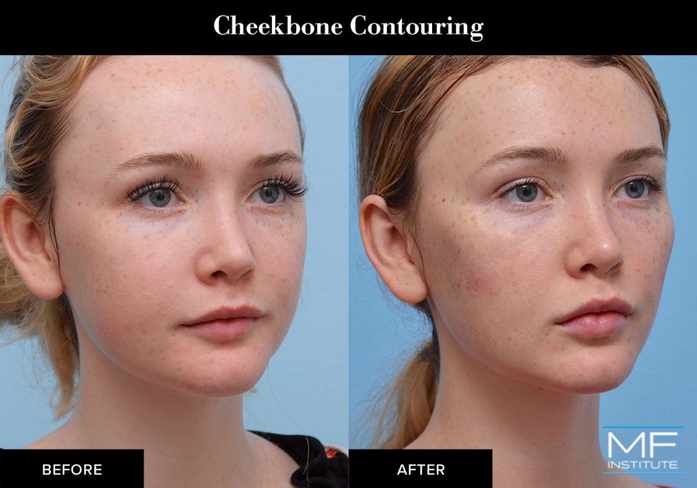 Cheekbone contouring and facial slimming with fillers and BOTOX.