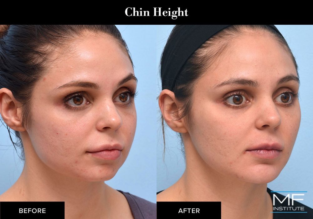 Before and After injectables in san francisco for a baby face