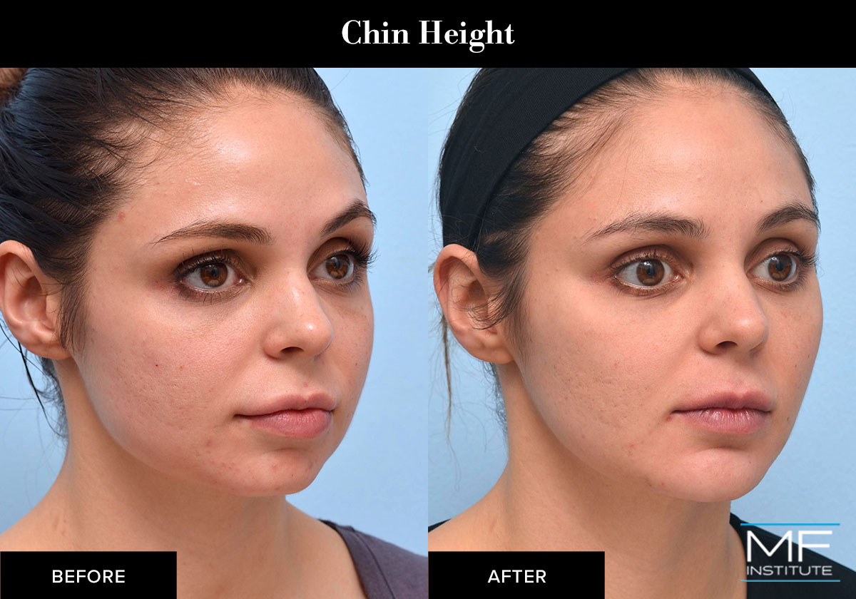 Chin dermal filler results