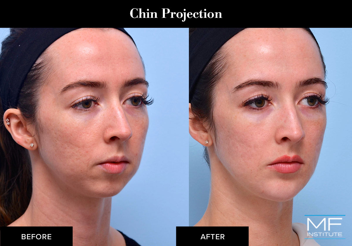 Chin dermal filler results