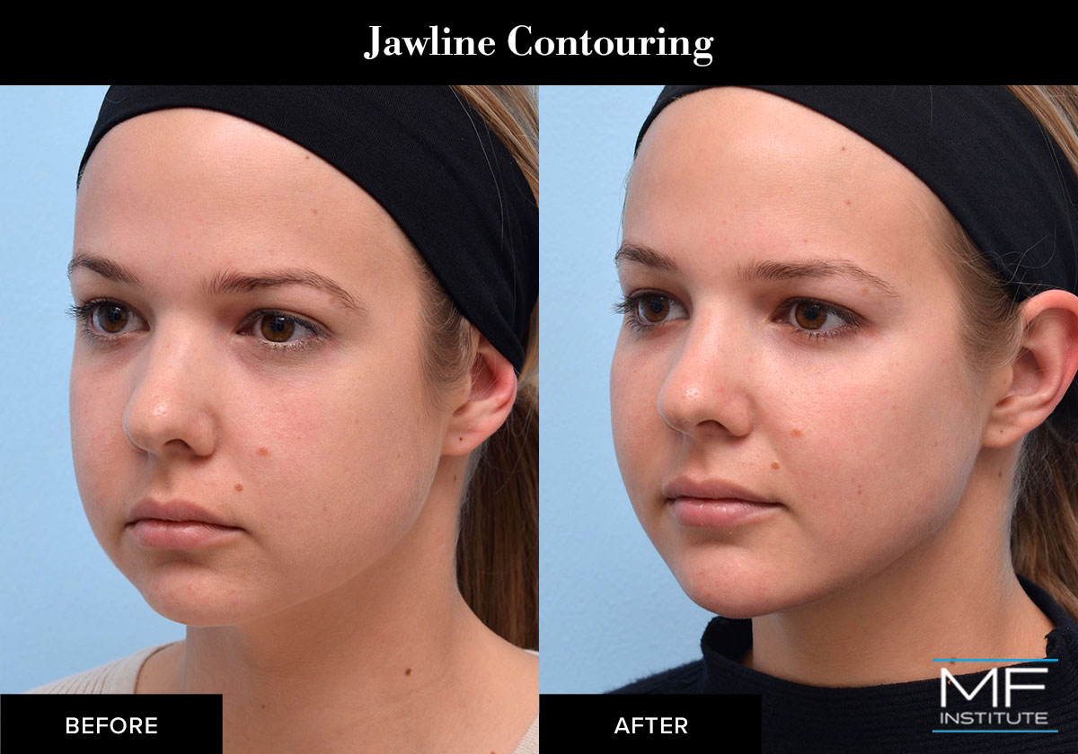 Jawline contouring results created with dermal fillers.