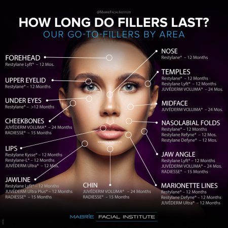 A diagram illustrating how long a specific filler procedure will last on a given treatment area