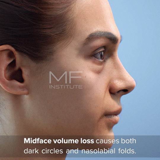Midface volume loss causes both dark circles and nasolabial folds.