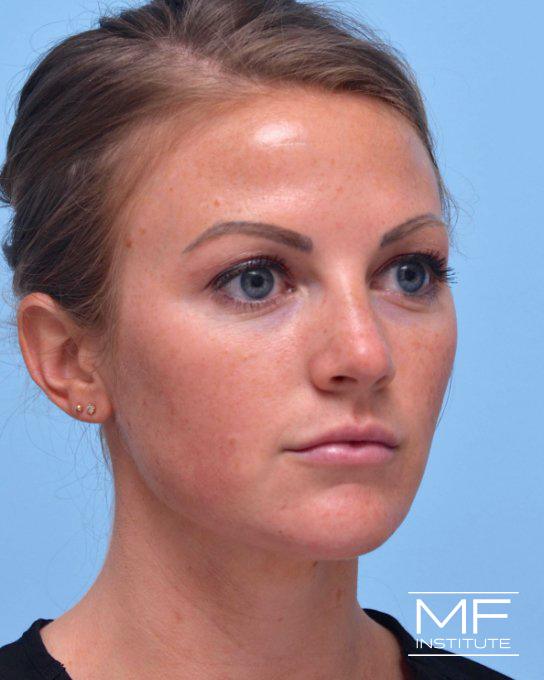 Cheek & Chin Contouring - After