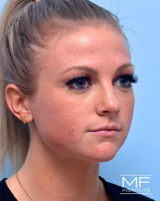 Cheek & Chin Contouring - Before