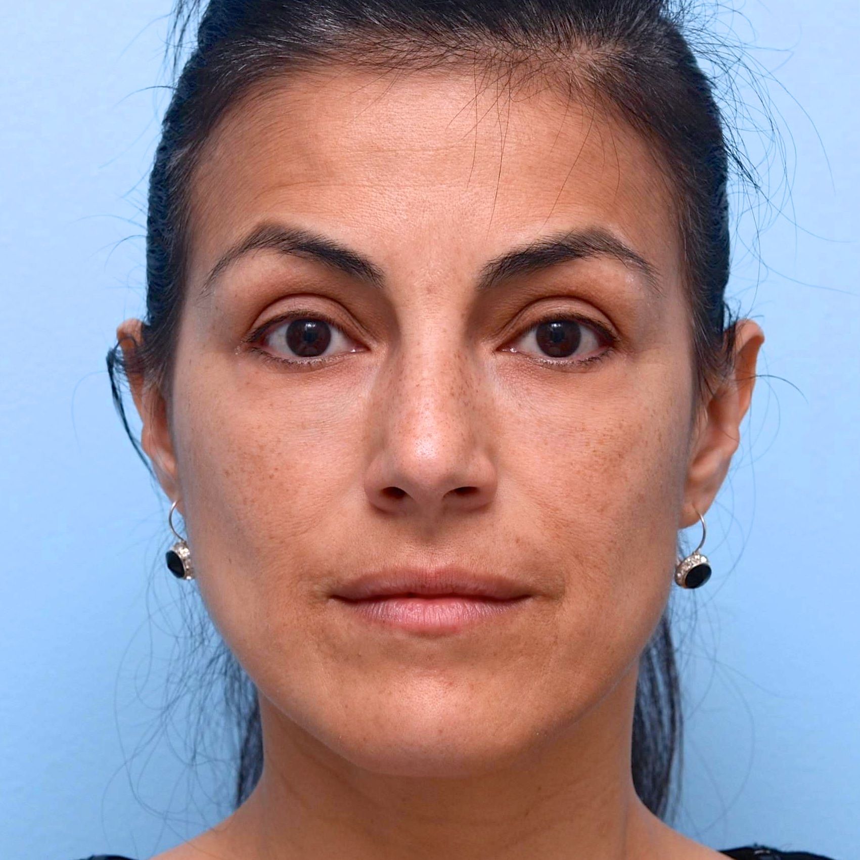 How Long Do Fillers Last? The Definitive Guide