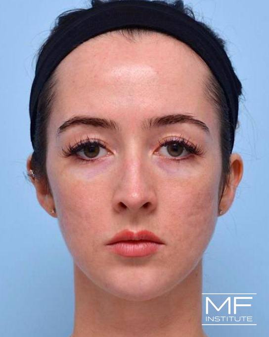 Jawline & Chin Contouring - Chin - Female - After