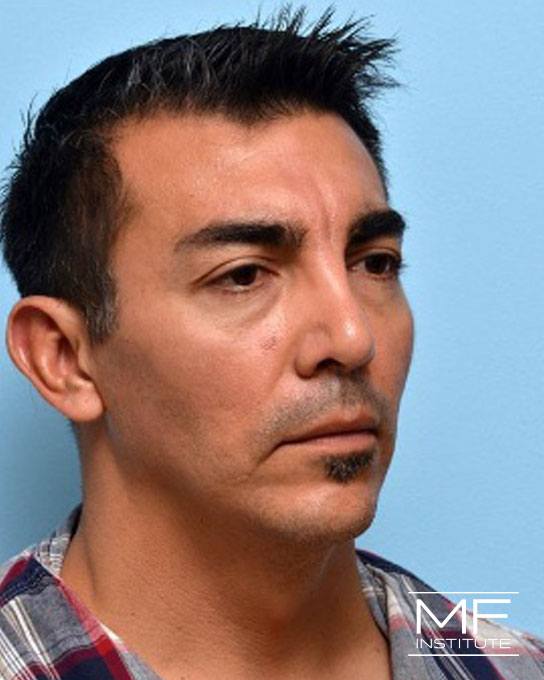 Jawline & Chin Contouring - Jawline - Male - Before