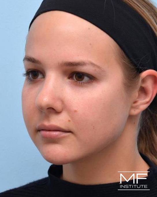 Jawline & Chin Contouring - Jawline - Female - After