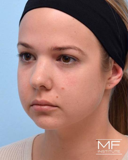Jawline & Chin Contouring - Jawline - Female - Before